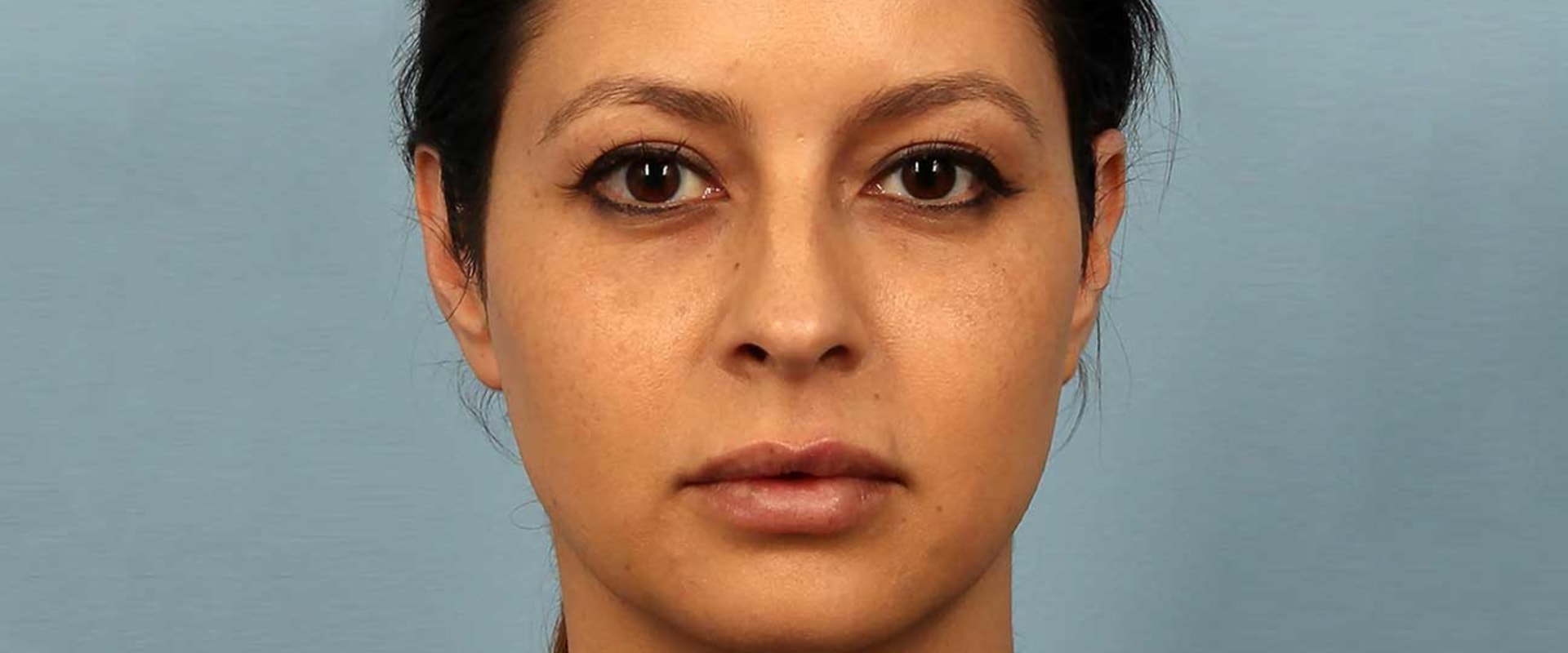 What Lasts Longer Botox or Restylane?