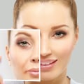 What areas can you use restylane?