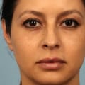 What Lasts Longer: Botox or Restylane?