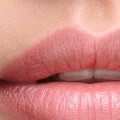 Can Restylane Be Used in Lips? - An Expert's Guide