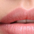 Can restylane be used in lips?