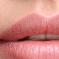 Will Lumps from Restylane Disappear?