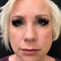 The Benefits of Restylane Lyft: A Comprehensive Guide