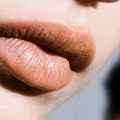 Should I Massage Restylane Lumps?