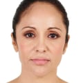 What is Restylane Made Of?