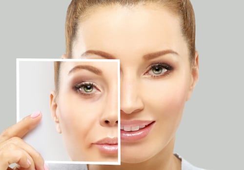What areas can you use restylane?