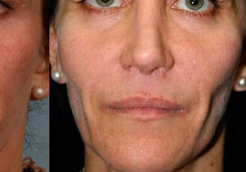 Where are Restylane Fillers Produced? An Expert's Perspective