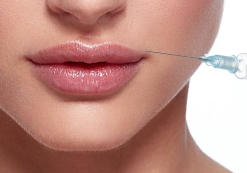 How Many Syringes of Restylane Do I Need for Lips?