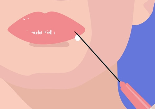 Is Restylane Worth It? A Comprehensive Guide