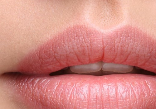 Can Restylane Be Used in Lips? - An Expert's Guide