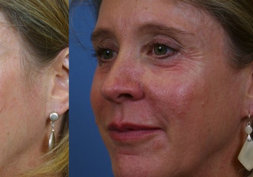 What is Restylane and Where is it Manufactured?