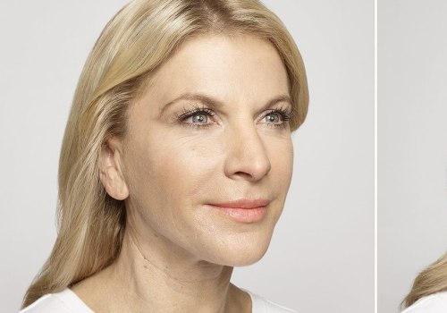 What to Expect After Restylane Treatment